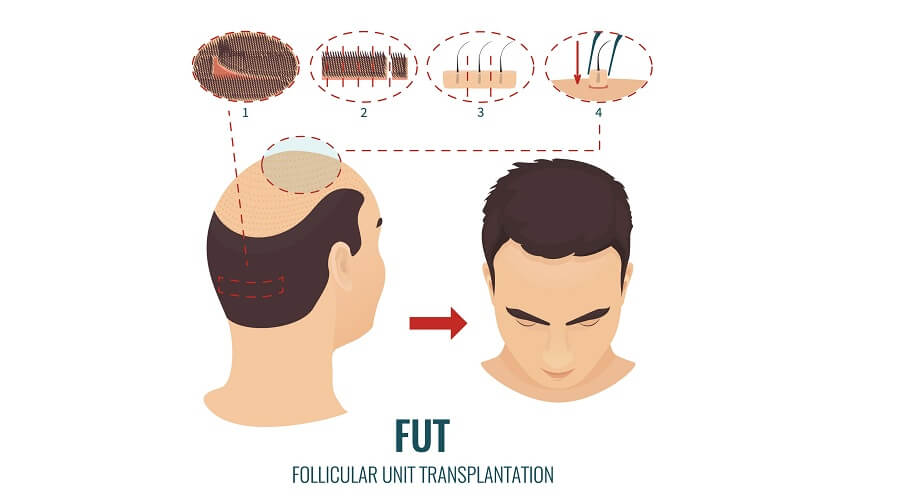 FUE Hair Transplant